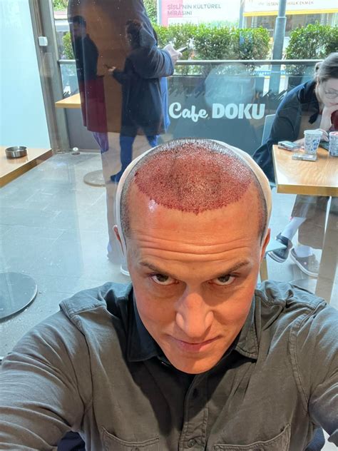 Experience with Dr Serkan Aygin : r/HairTransplants .